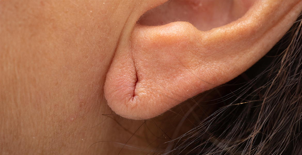 Ear Lobe Repair | Earlobe Repair Surgery Treatment in Coimbatore